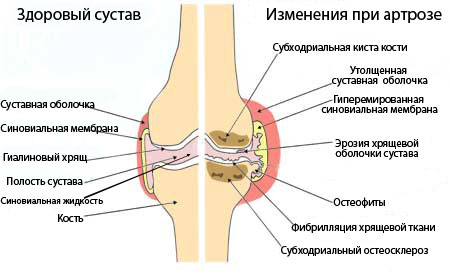 Як правильно харчуватися при артрозі