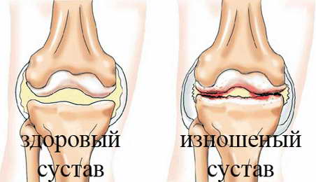 Як правильно харчуватися при артрозі