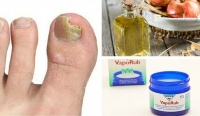6 природных средств от грибка на ногтях
