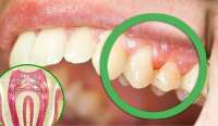 6 вероятных причин зубной боли